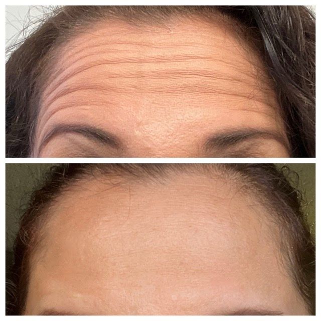 A before and after photo of a woman 's forehead with wrinkles.