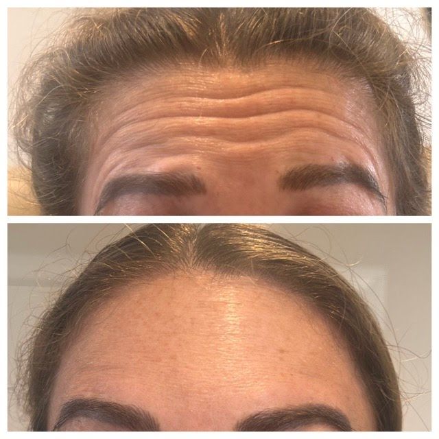 A woman 's forehead before and after botox injections.