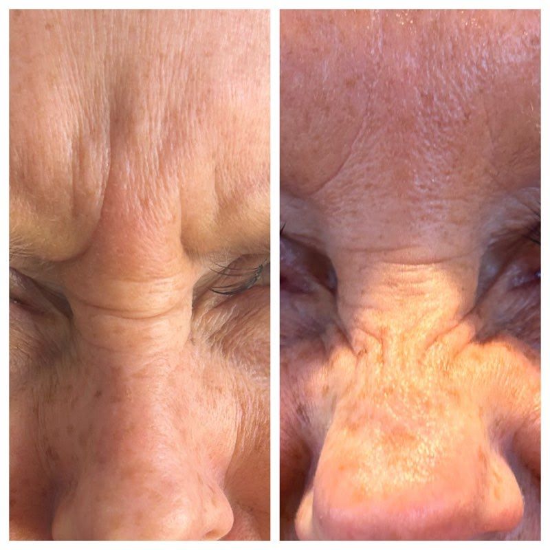 Before and after of a woman's face