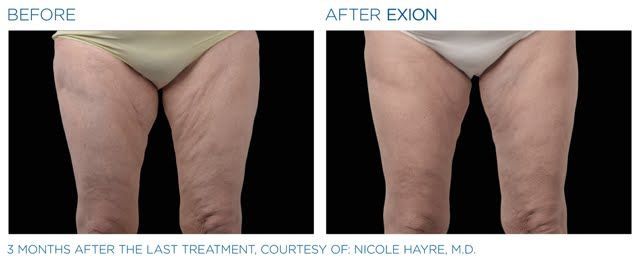 Before and after of a woman's thighs