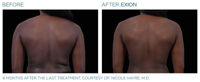 A before and after picture of a woman 's back.