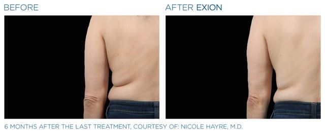 A before and after photo of a woman 's back and arms.