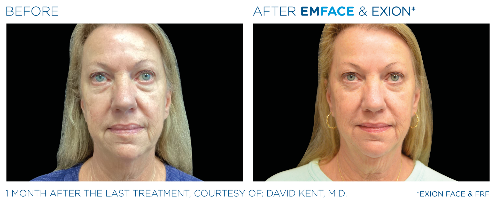 A before and after photo of a woman 's face.