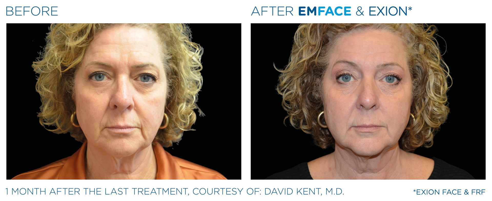 A before and after photo of a woman 's face.