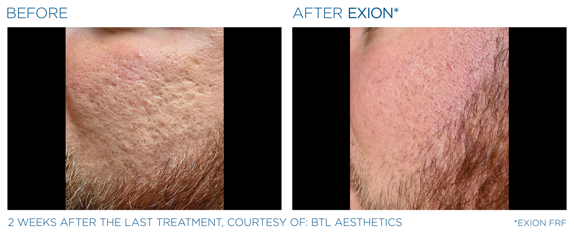 A before and after photo of a man 's beard.