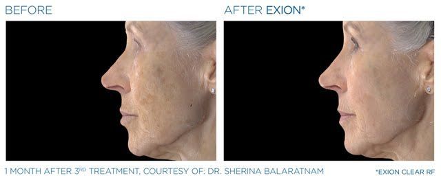 A before and after photo of a woman 's face.