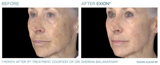 A before and after photo of a woman 's face.