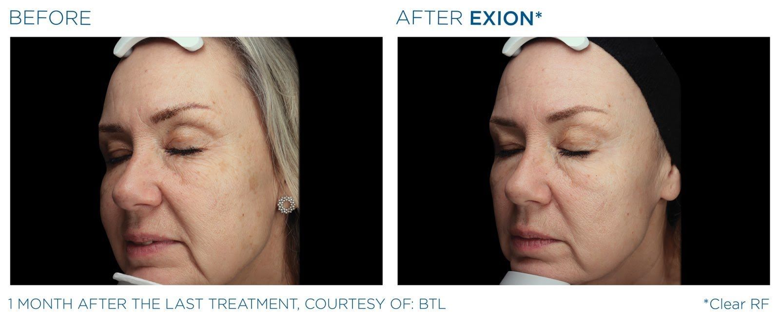 A before and after photo of a woman 's face.