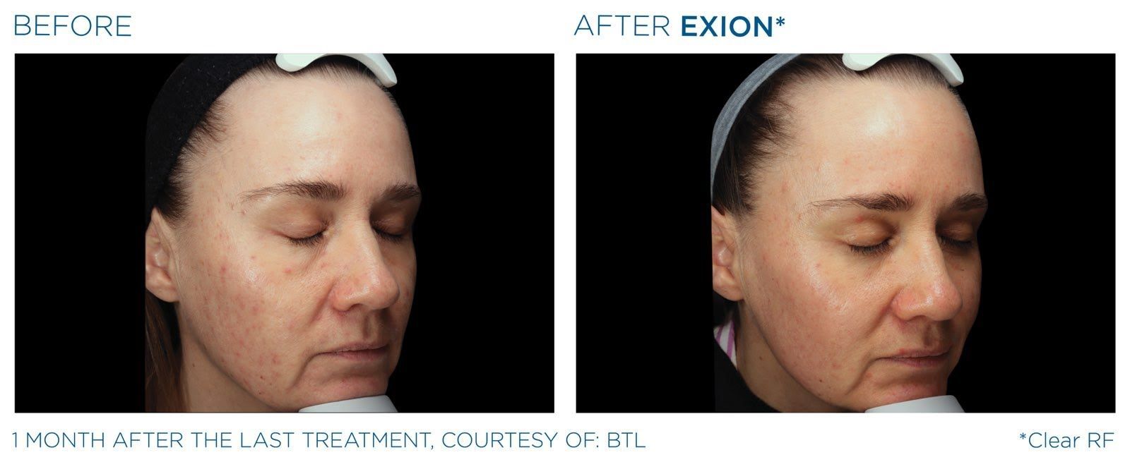 A before and after photo of a woman 's face with her eyes closed.