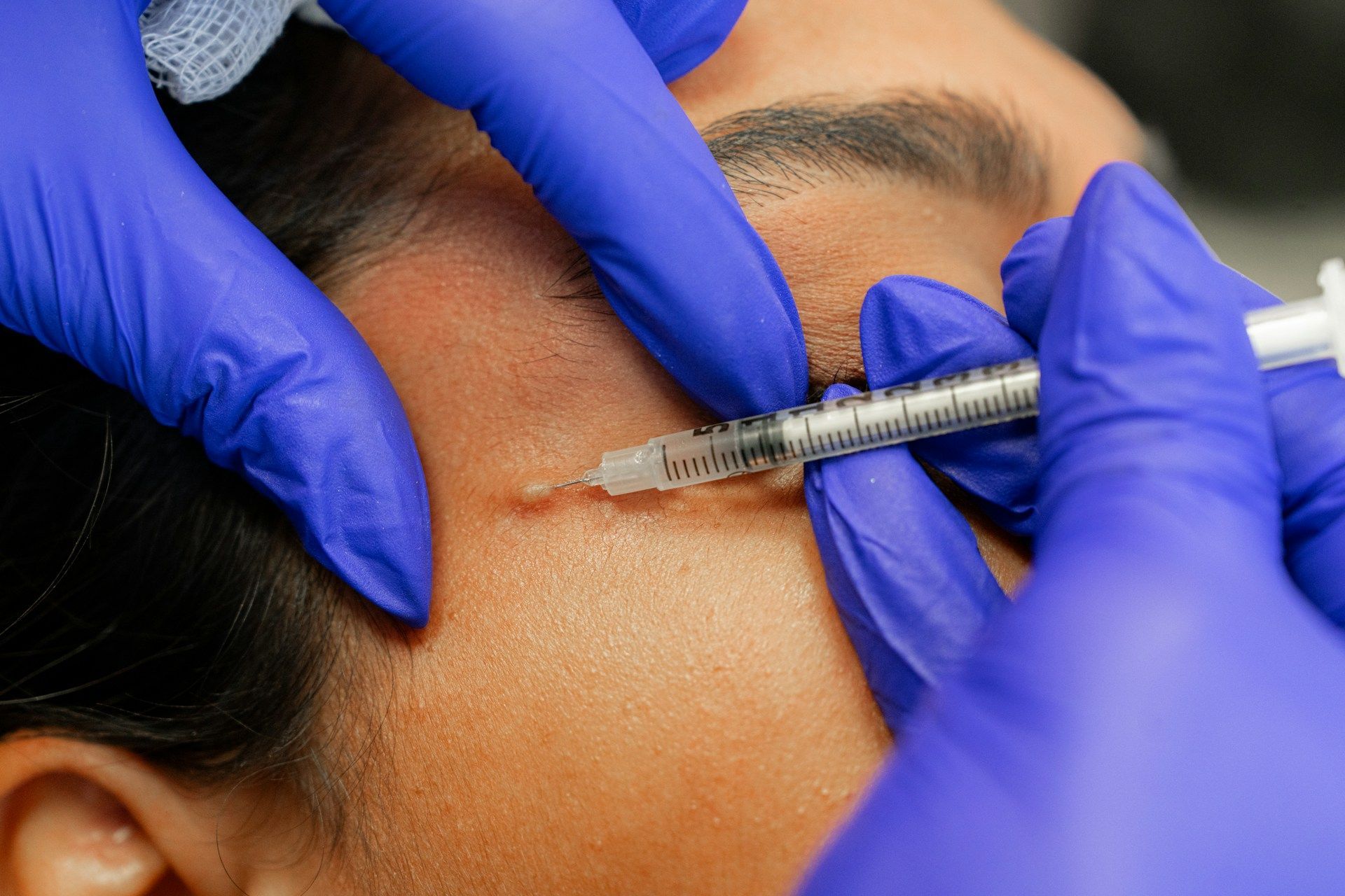 botox treatment