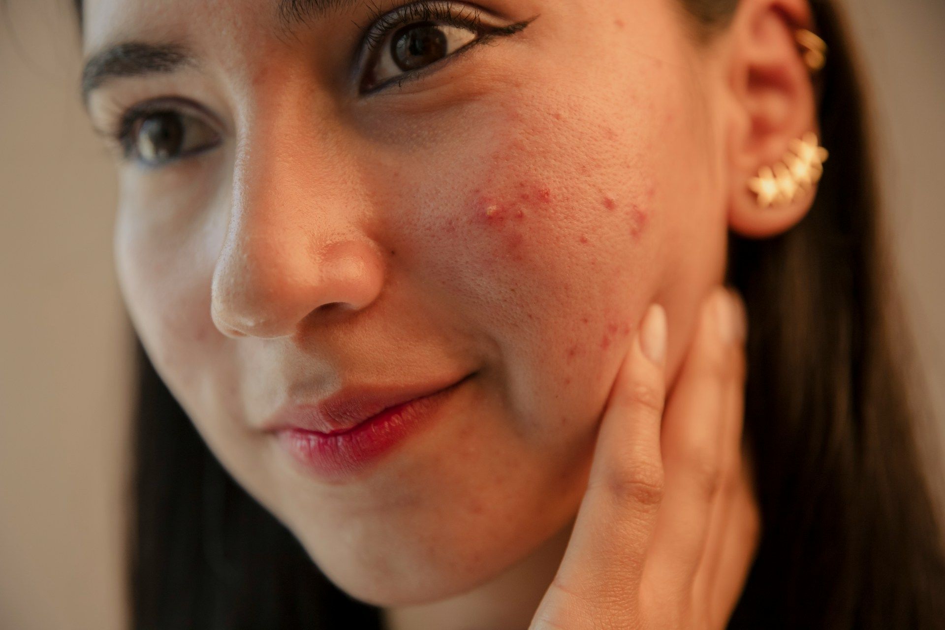 hormonal acne breakout