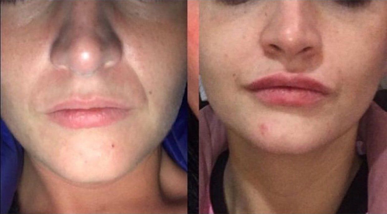 Dermal Filler Lips Before and After
