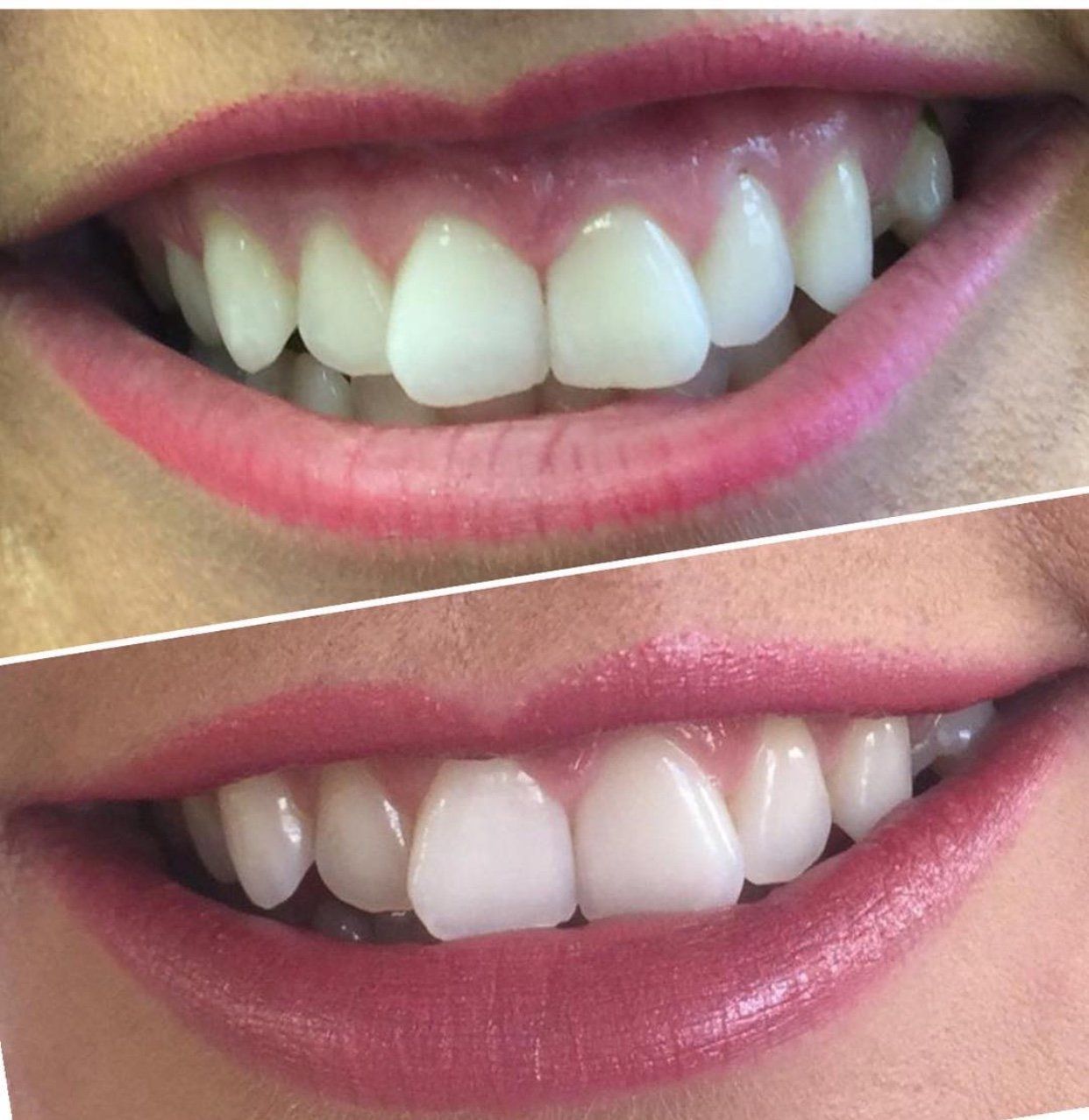 Dermal Filler Lips Before and After