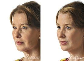 Dermal Filler Skin Revitalisation Before and After