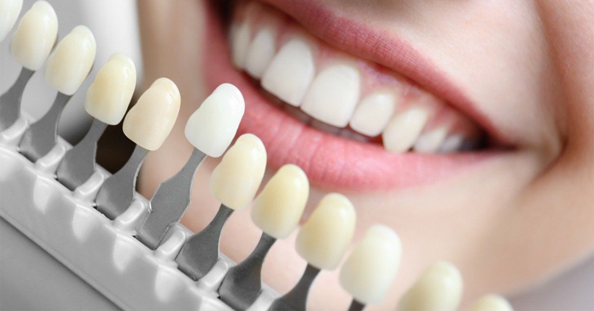 Choosing the Right Teeth Whitening Service