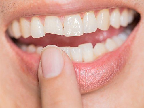 Dental Emergencies