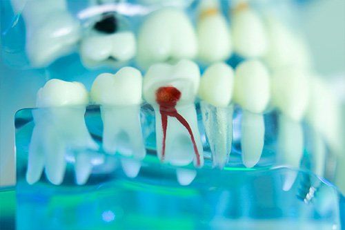 a close up of a model of teeth with a red root canal .