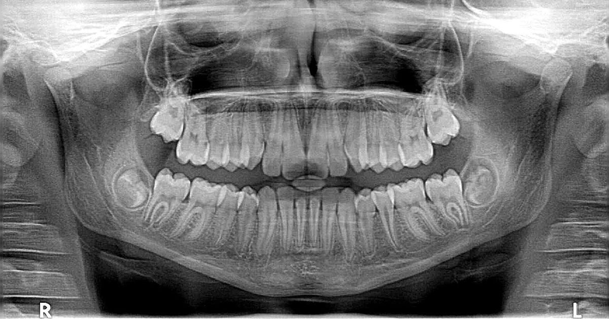 A black and white x-ray of a person 's teeth.