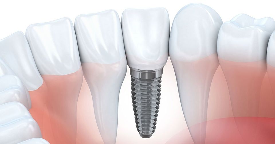 What Happens During a Tooth Implant Process? A Dental Implant Timeline