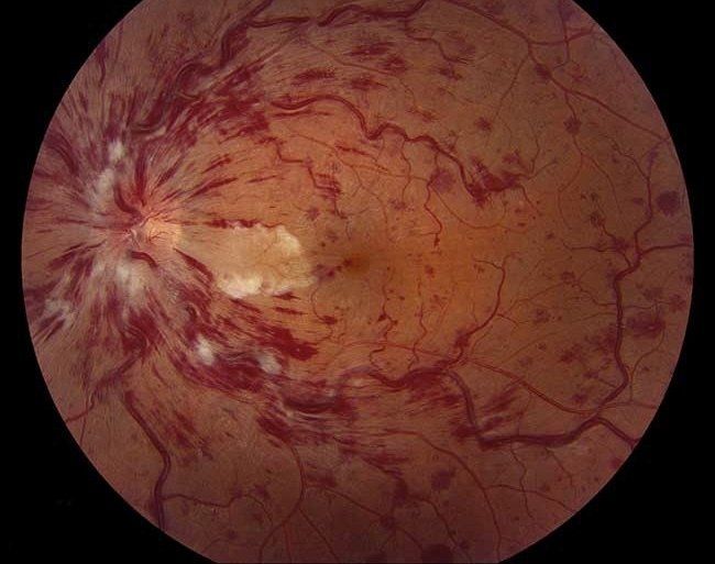 Retinal Vein Occlusion