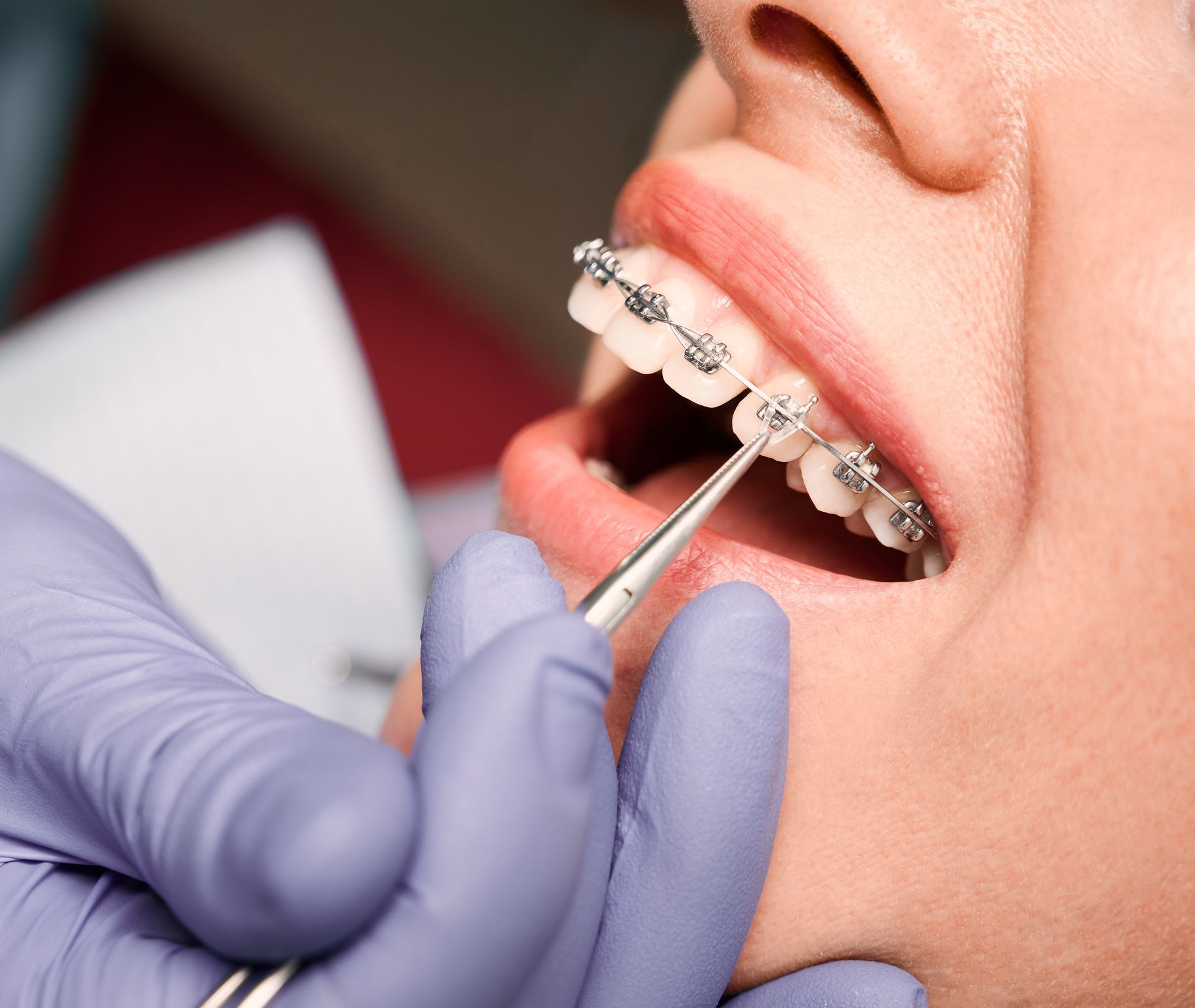 Close-up of a dentist's hand in gloves putting an elastic rubber band on the patient's brackets.