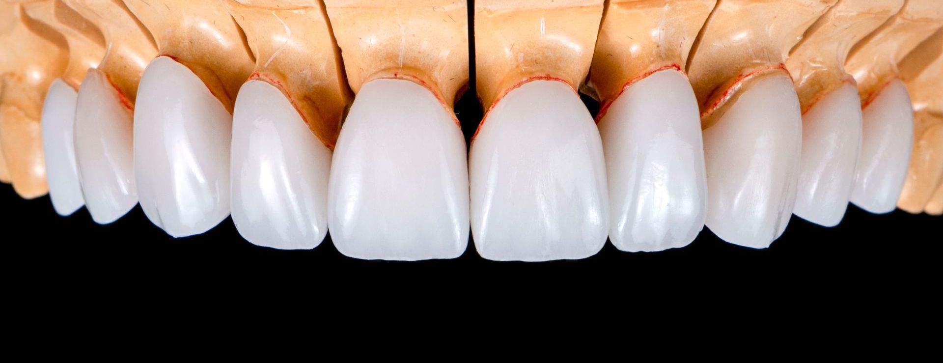 Close-up of a dental cast showing perfect, white, porcelain veneers, with a black background.
