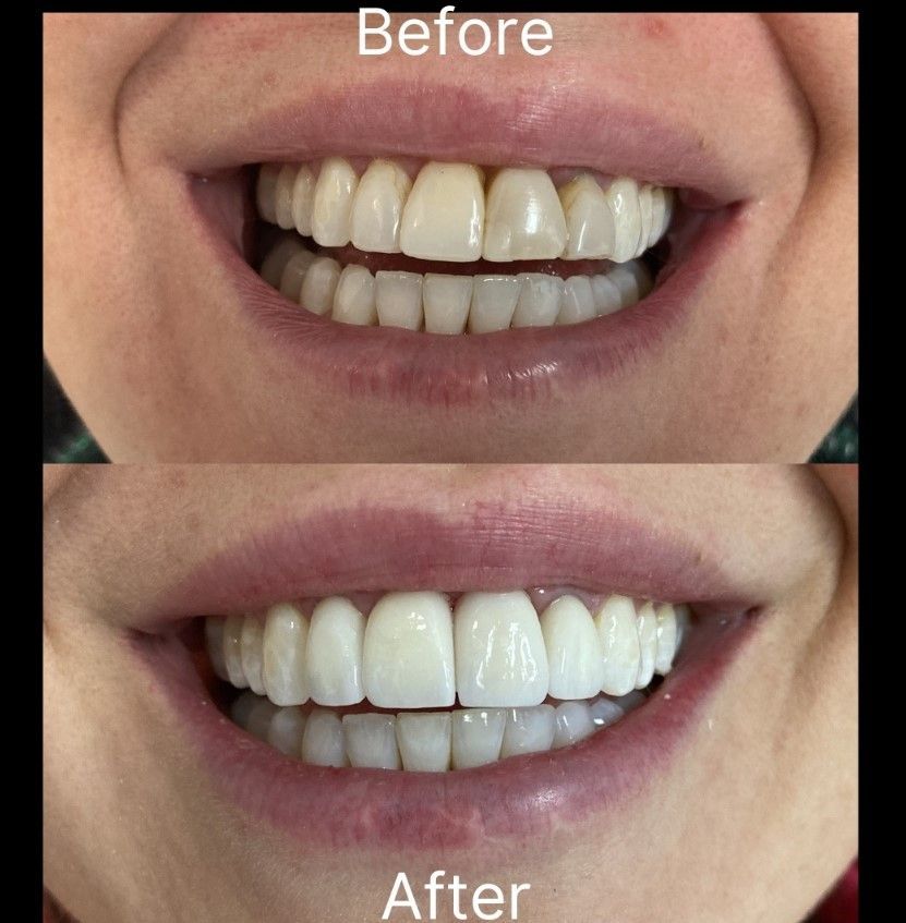 Comparison of a person's teeth before and after cosmetic dental work: brighter and more uniform.