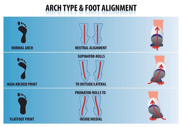 Diagram comparing foot arch types (normal, high, flat) to foot alignment (neutral, supinator, pronator) with illustrations.