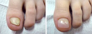 Two close-up views of a toe, one with a discolored, unhealthy nail, the other with a healthy nail.