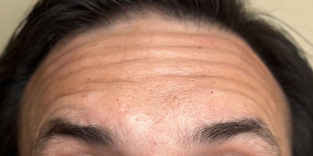 Male Before Botox for Glabellar Lines