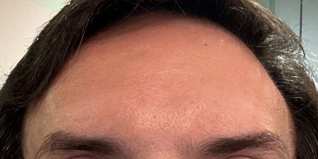 Male After Botox for Glabellar Lines