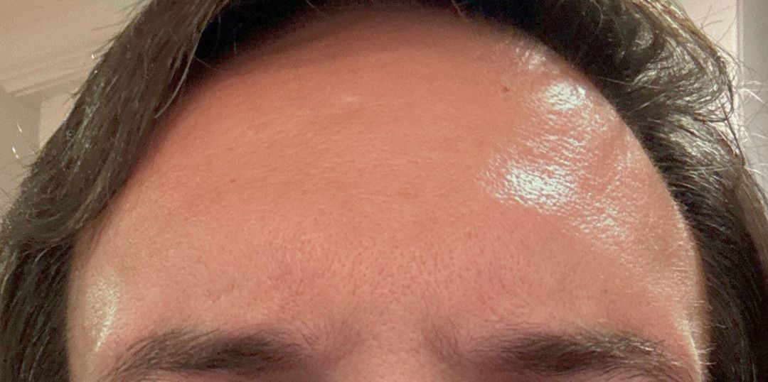 Male After Dysport between the eyes