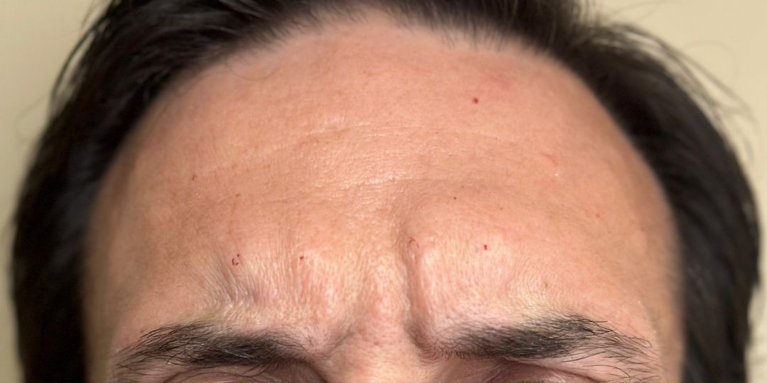 Male After Dysport between the eyes