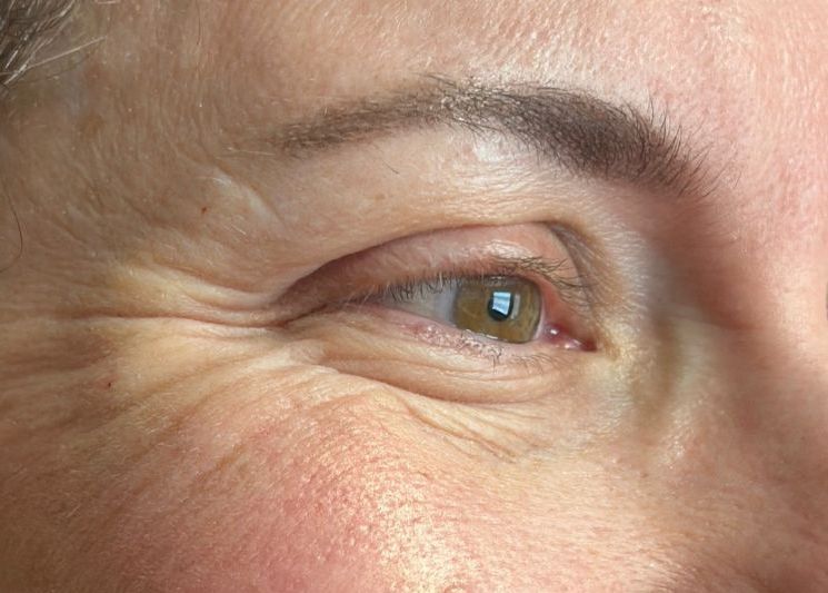 Female Before Dysport