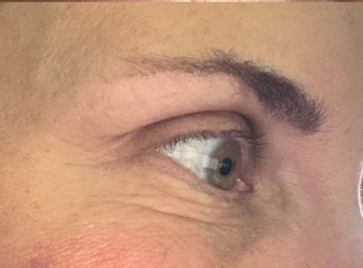 Female After Dysport