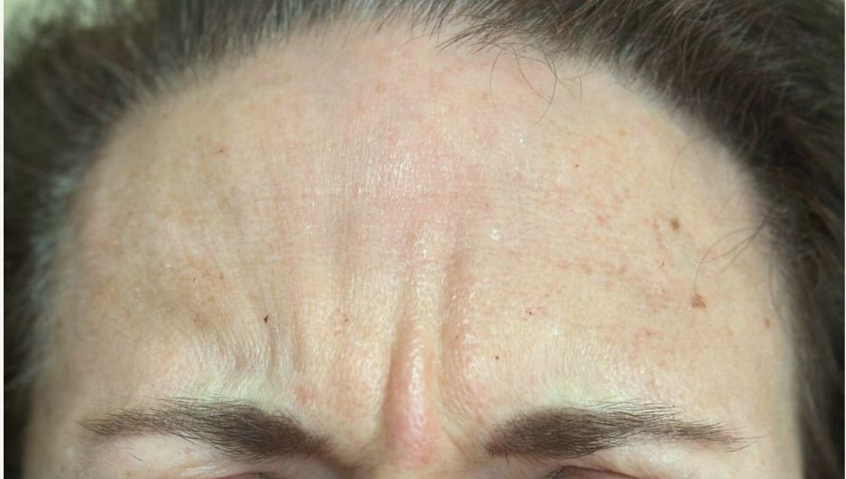 Female Before Dysport