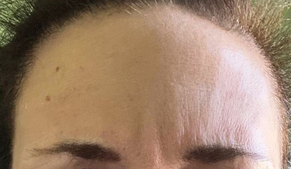 Female After Dysport