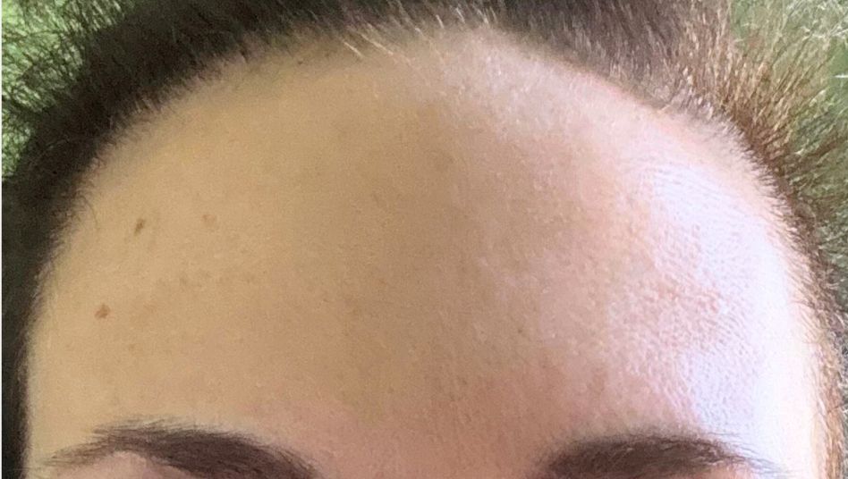 Female After Dysport