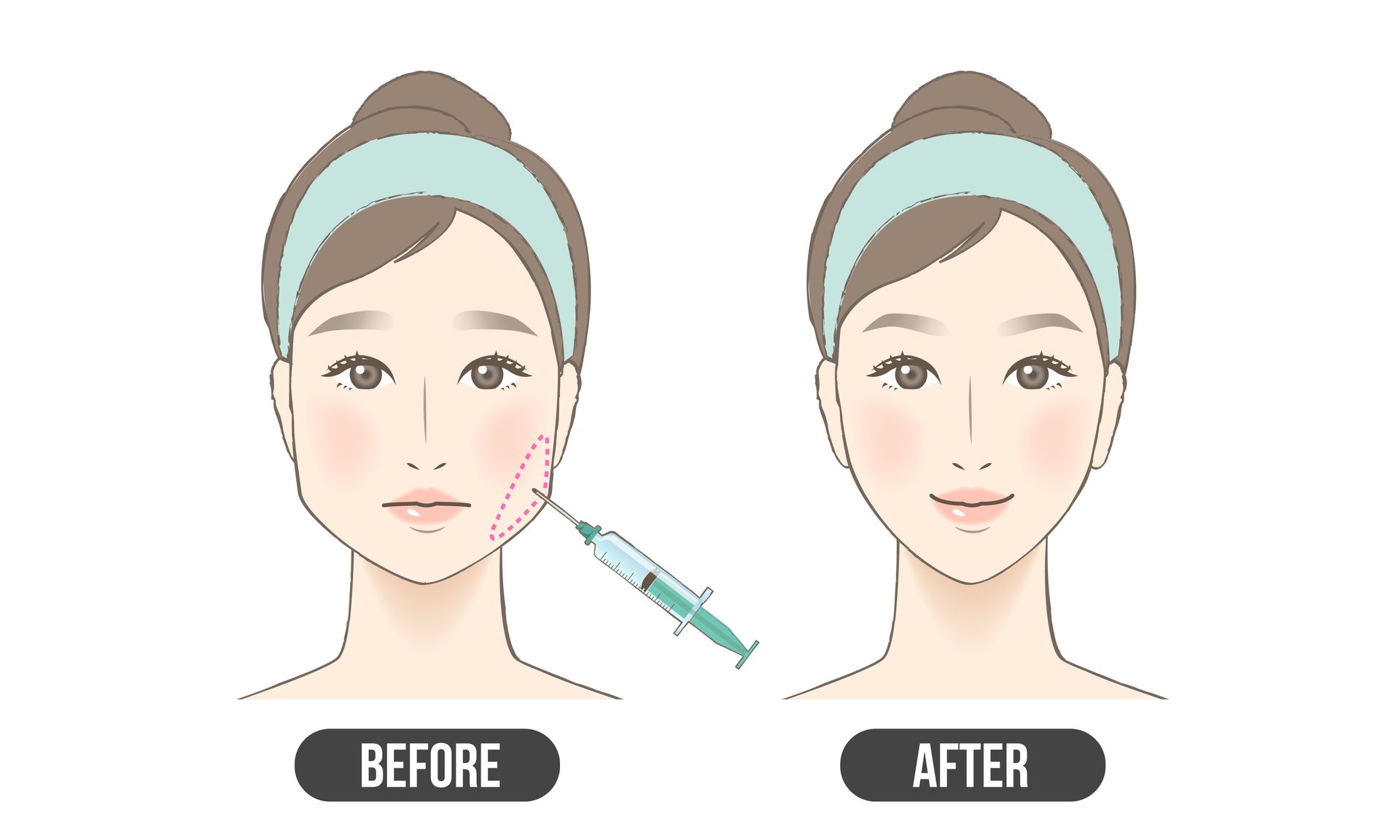 masseter botox drawing before and after