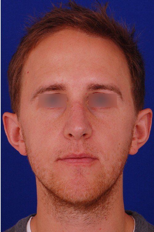 male rhinoplasty after