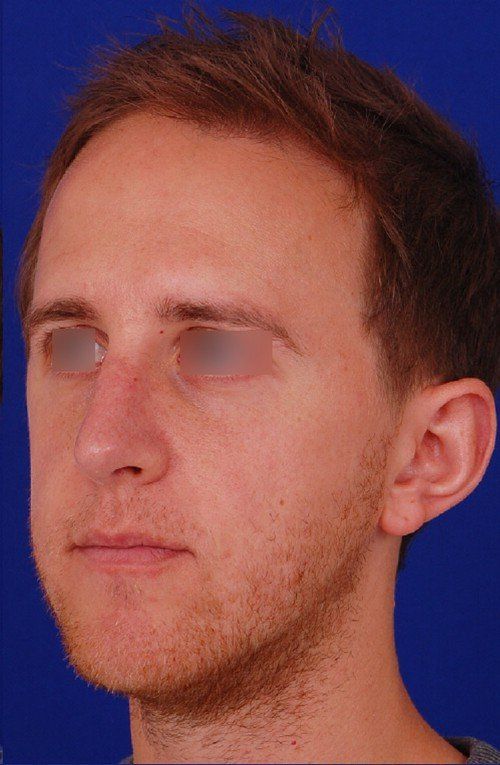 male rhinoplasty after
