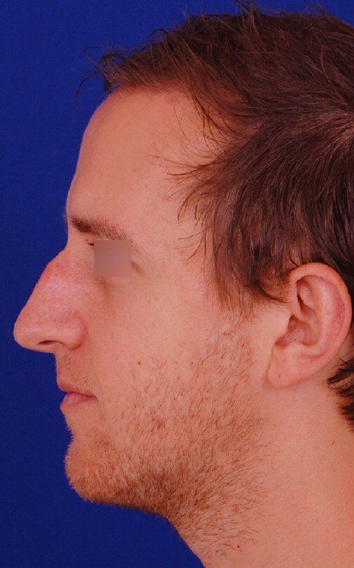 How Rhinoplasty Can Reshape The Bridge Of The Nose