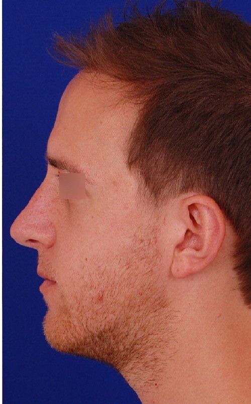 male rhinoplasty after