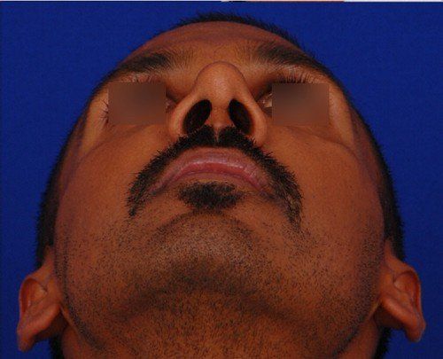 male rhinoplasty after