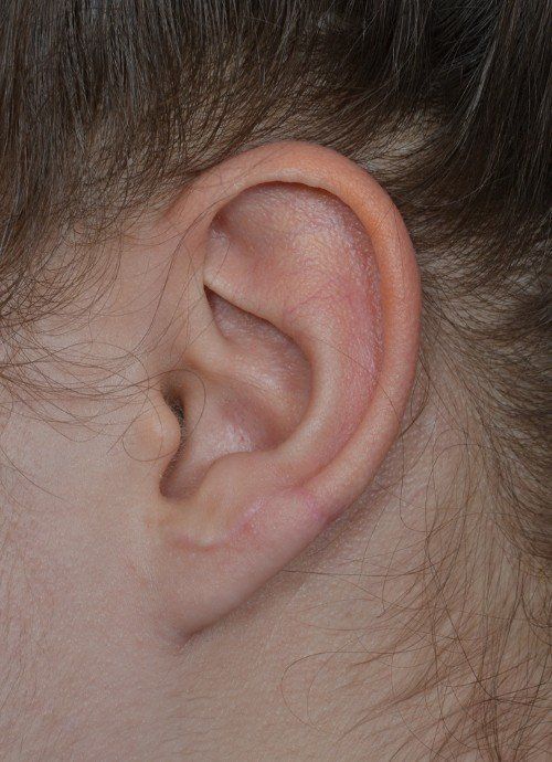 ear after earlobe surgery