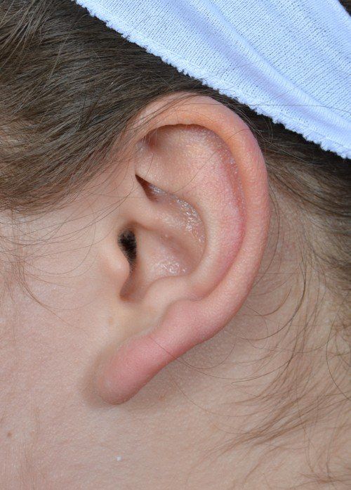 ear before earlobe surgery