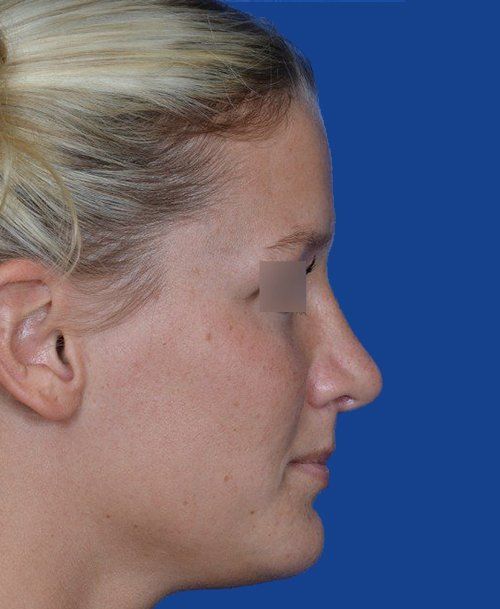 Female Rhinoplasty After Picture