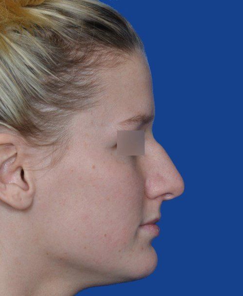 Female Rhinoplasty Before Picture