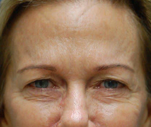 Female After Botox for Crows's Feet and Glabellar Lines