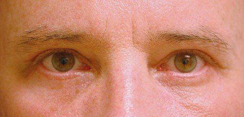 Upper Eyelid Surgery For Hooded Eyes 